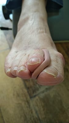 Ecarteur interdigital