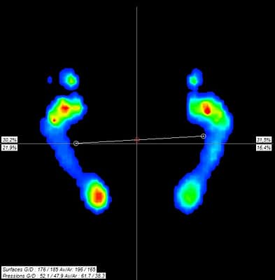 Mesure baropodométrique